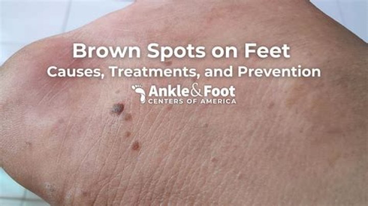 What do brown spots in your iris mean?