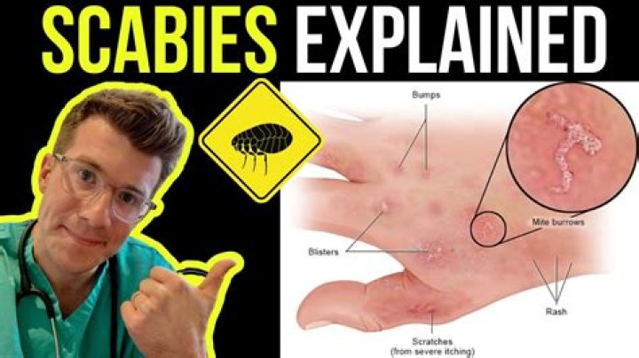 What do scabies bites look like?