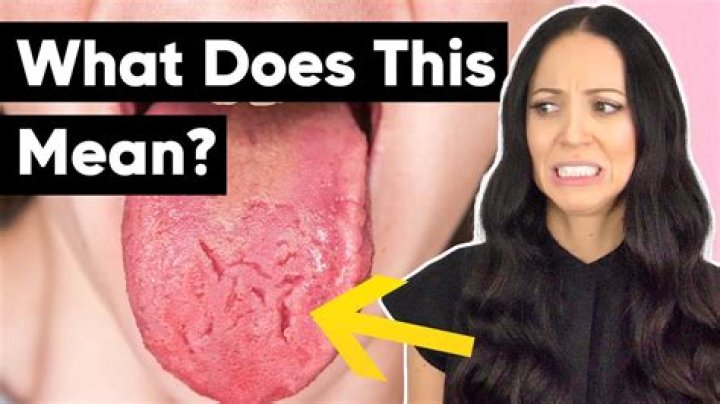 What does a fat tongue mean?