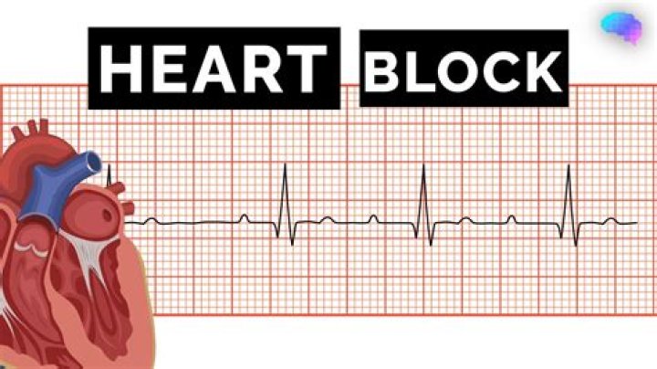 What does a heart blockage feel like?