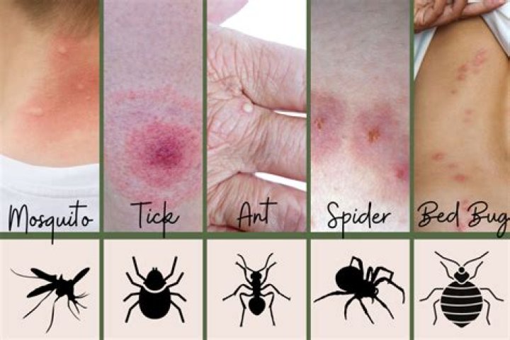 What does a ring around a bug bite mean?