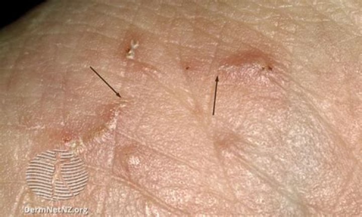What does a Scabie look like?