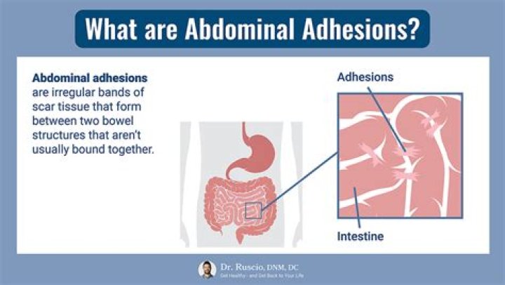What does adhesions look like?