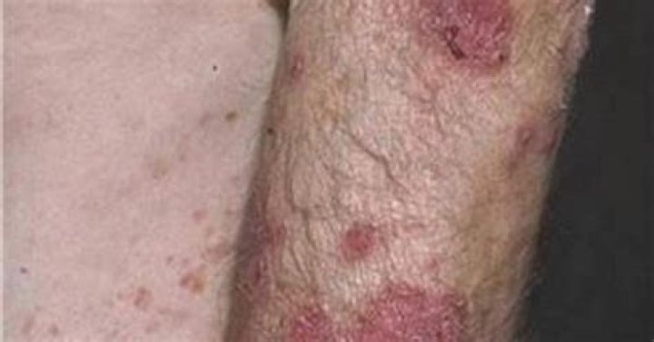 What does chlamydia look like on a guy?