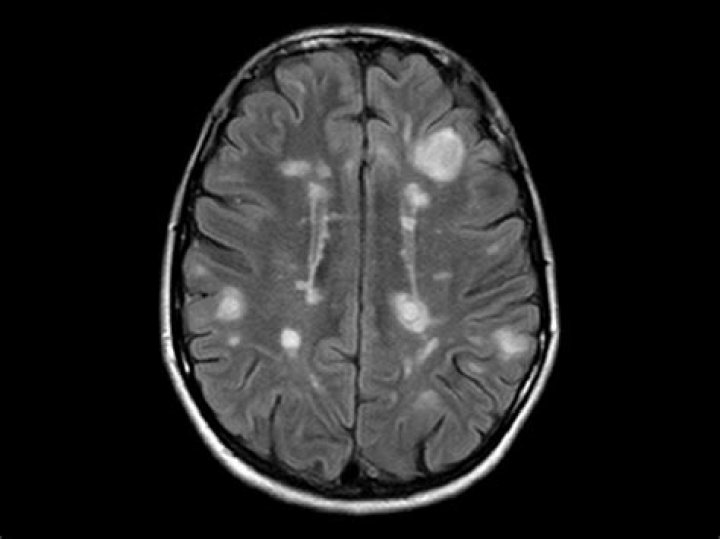 What does early MS look like on MRI?