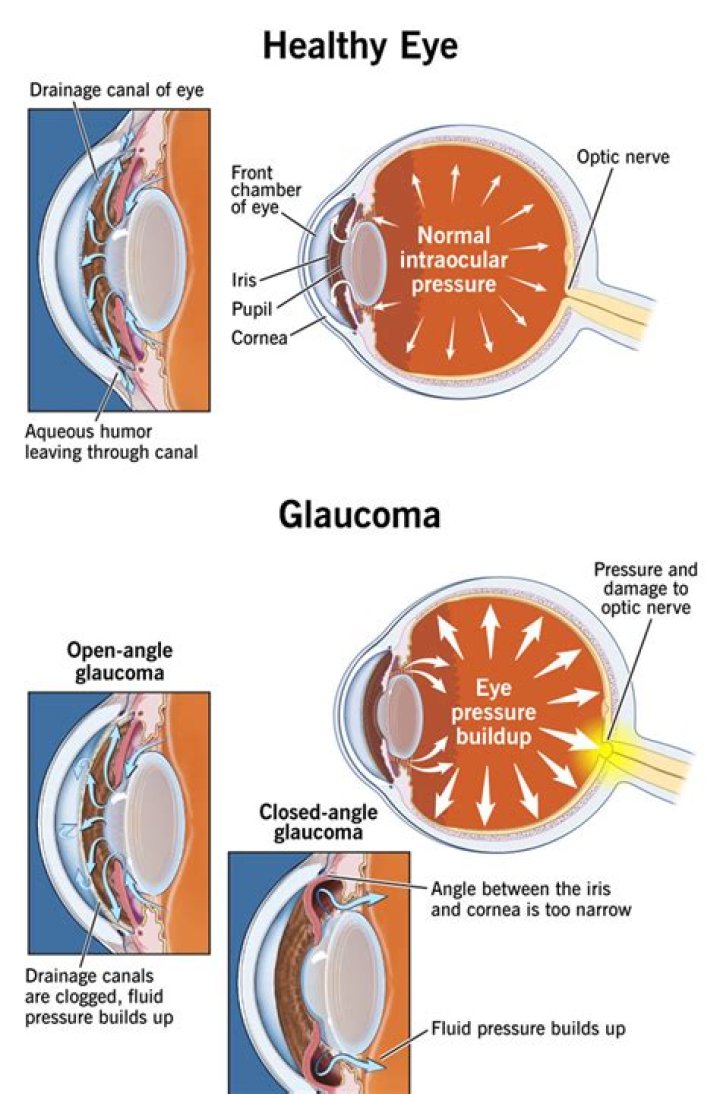 What does glaucoma pressure feel like?