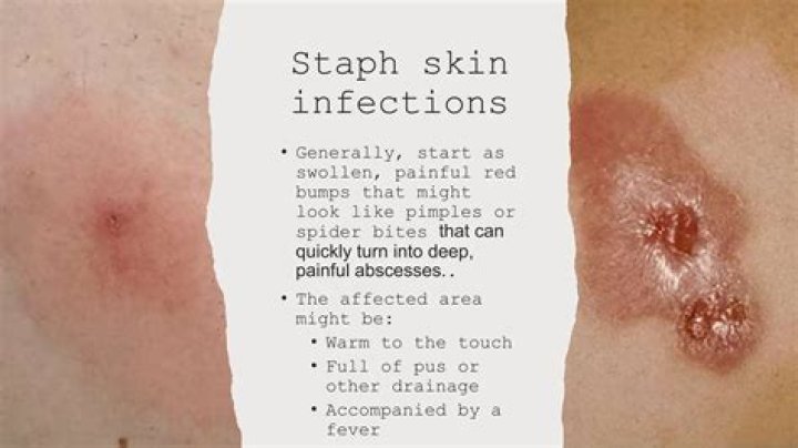 What does staph look like when it starts?