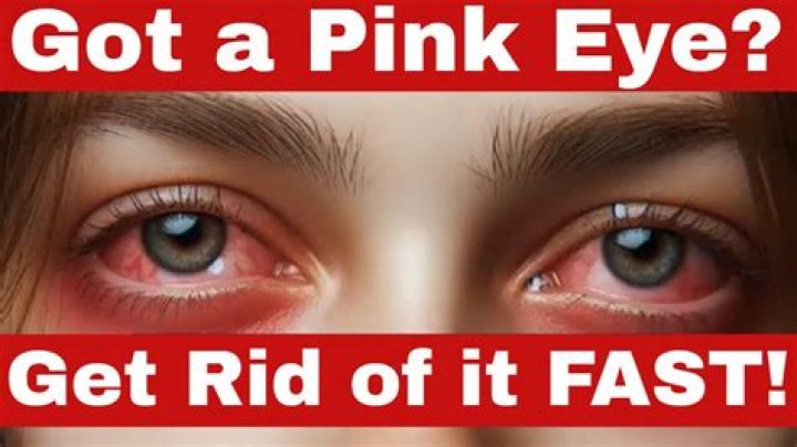What gets rid of pink eye fast?