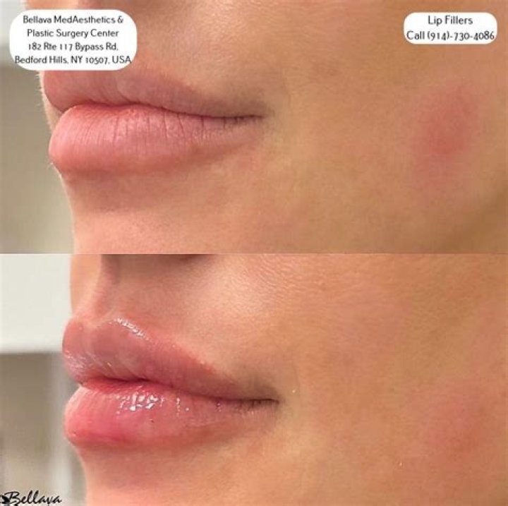 What happens after lip lock?