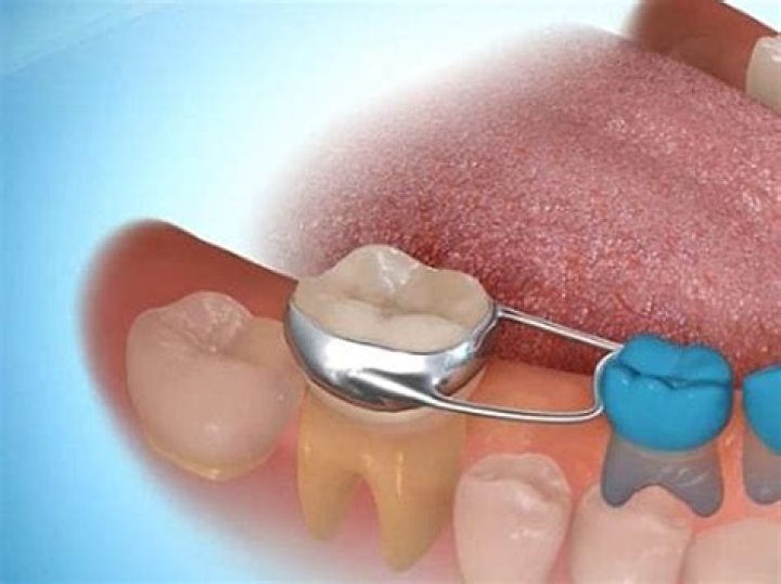 What happens after spacers are removed?