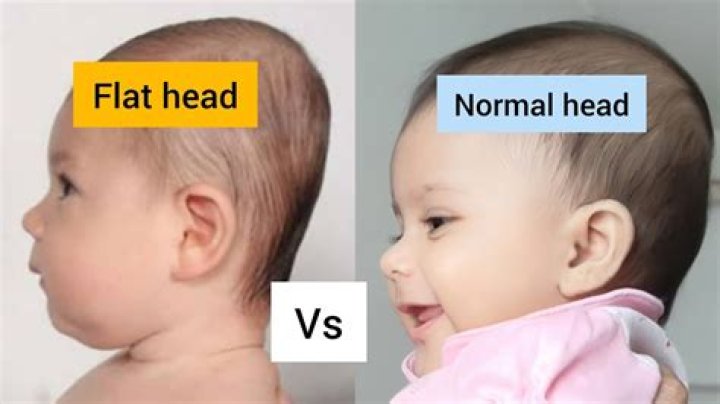 What happens if flat head isn't treated?