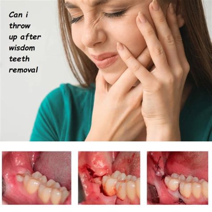 What happens if I accidentally spit after wisdom teeth?