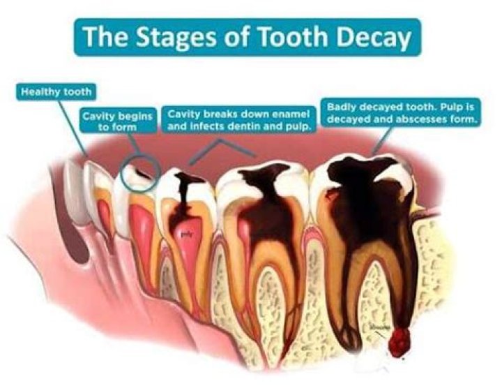 What happens if tooth decay is left untreated?