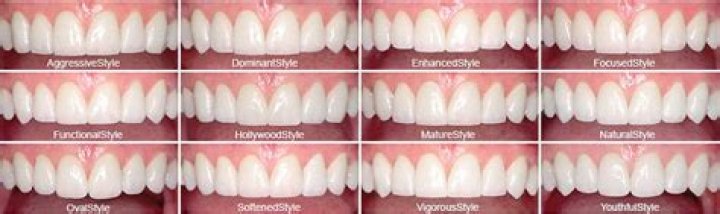 What happens if you don't like your veneers color?