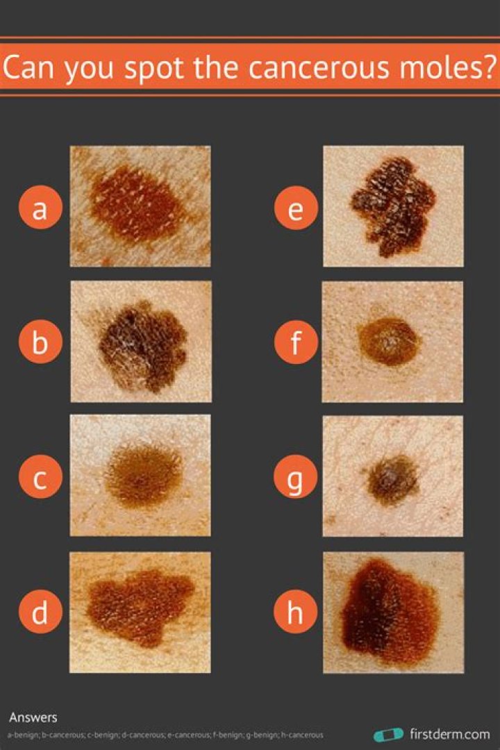What happens if you have a cancerous mole?