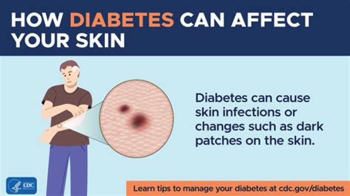What helps diabetic skin?