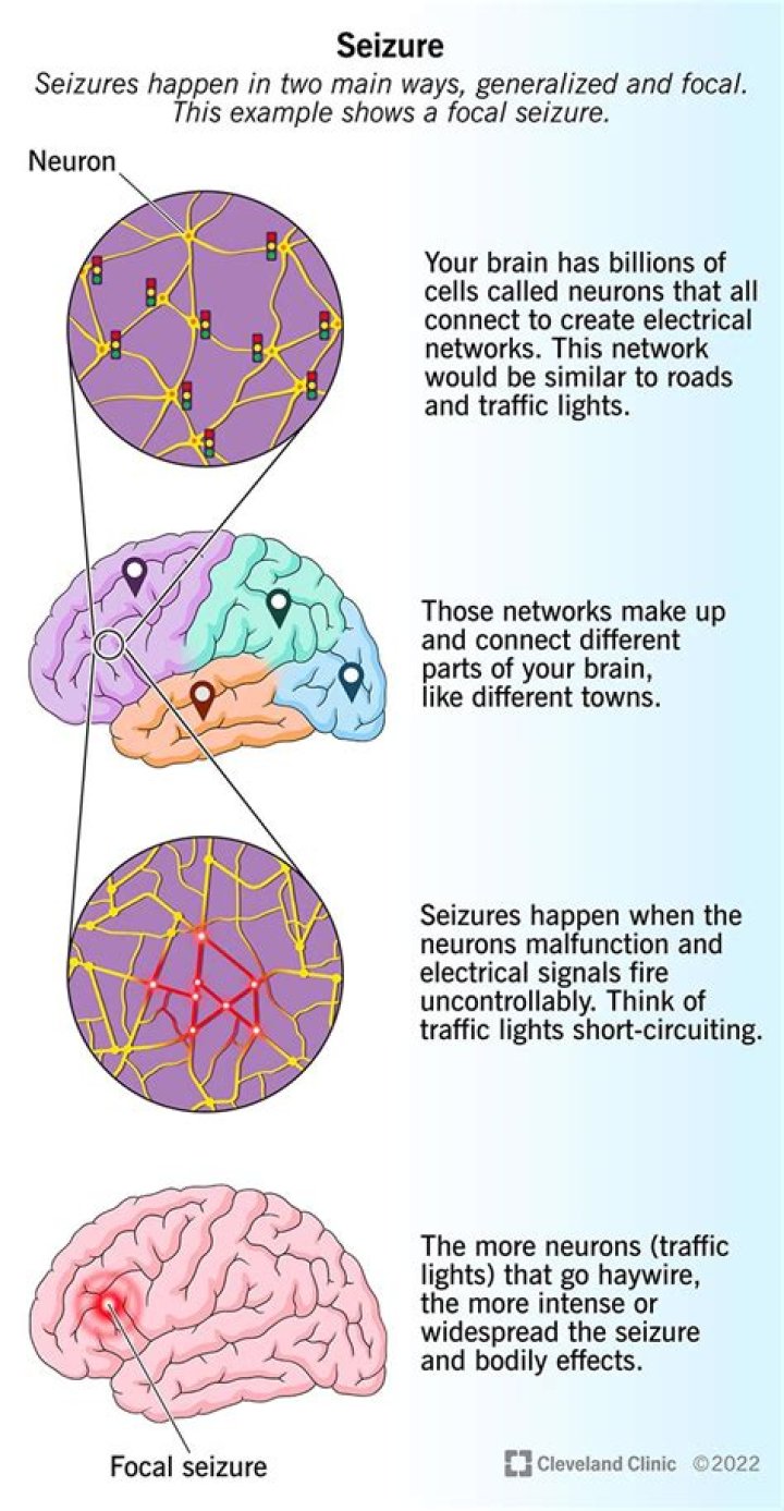 What is a aura seizure?