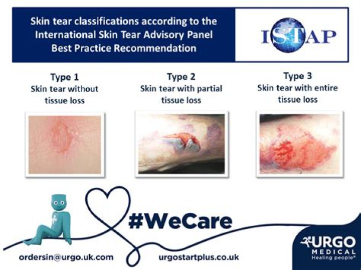 What is a Category 2 skin tear?