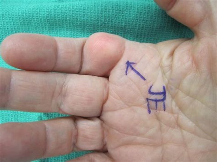 What is a pea sized lump in palm of hand?