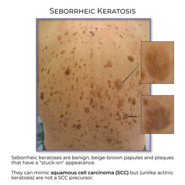 What is a seborrheic keratosis made of?