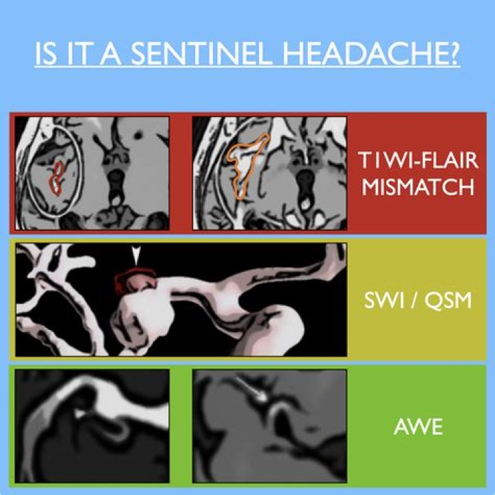 What is a sentinel headache?