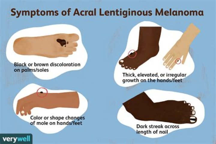 What is acral melanoma?