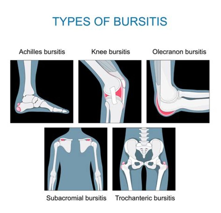 What is chronic bursitis?