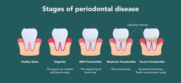 What is considered severe periodontal disease?