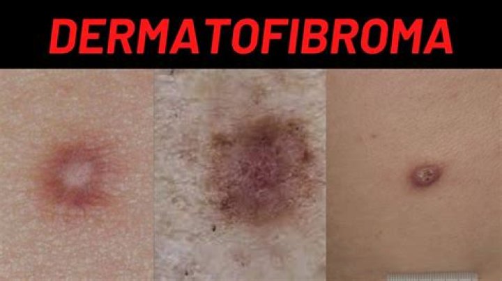 What is Dermatofibrosis?