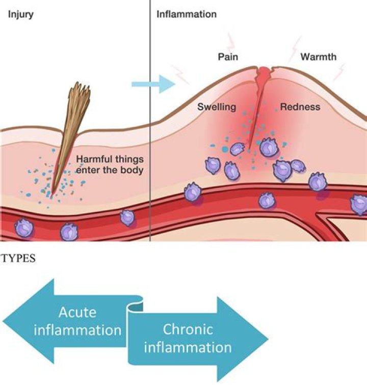 What is inflammation What are the symptoms and signs of inflammation?