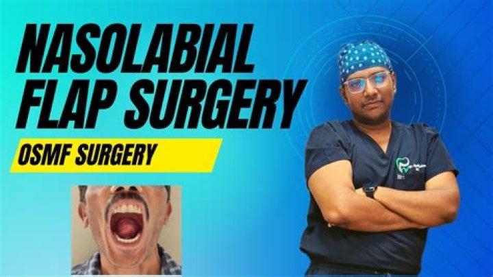 What is nasolabial flap?