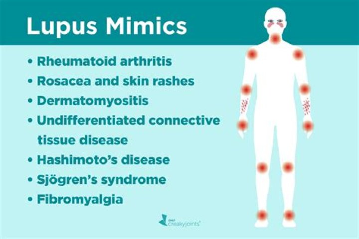 What is often misdiagnosed as lupus?