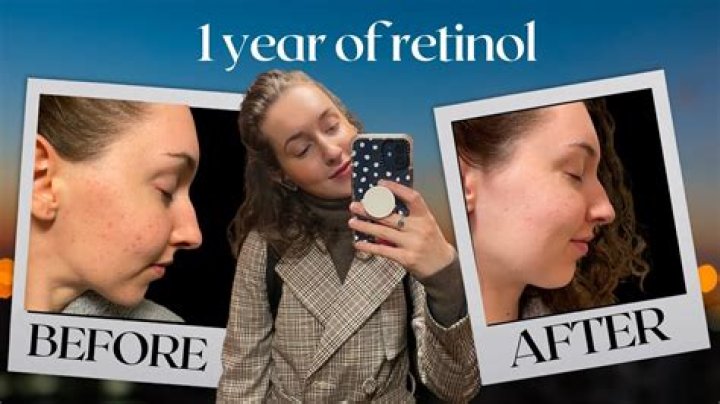 What is retinol uglies?