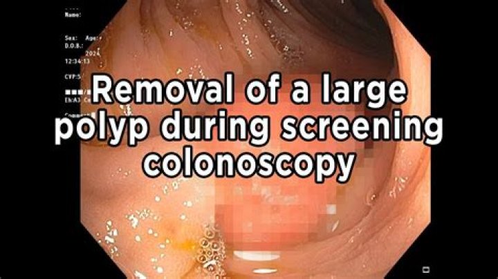 What is the average number of polyps removed during a colonoscopy?