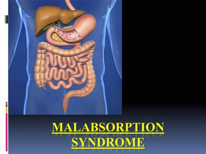 What is the classic symptom of malabsorption syndrome?