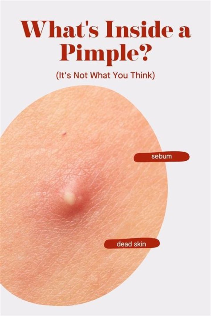 What is the little hard thing inside a pimple?