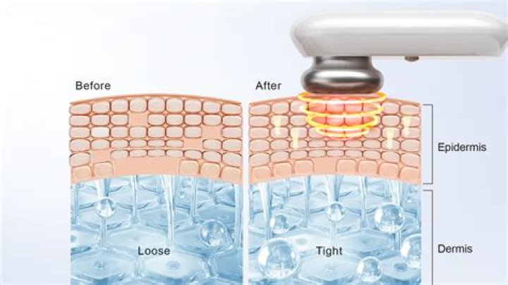 What is the main active ingredient in skin tightening?
