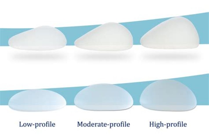 What is the most natural breast implant size?