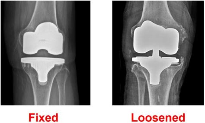 What is the safest knee replacement?