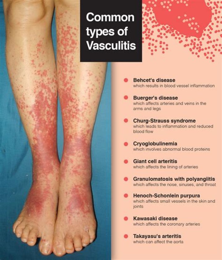 What is vasculitis rash?