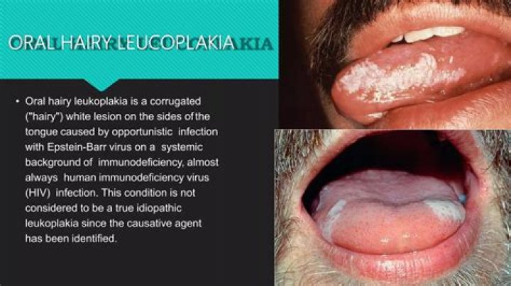 What is vocal cord leukoplakia?
