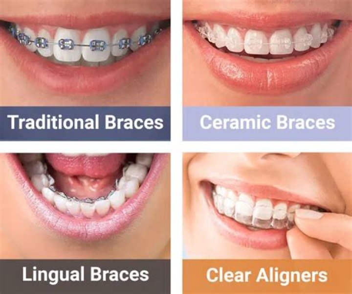 What kind of braces are better?