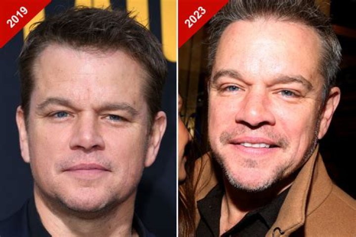 What male celebrities have plastic surgery?