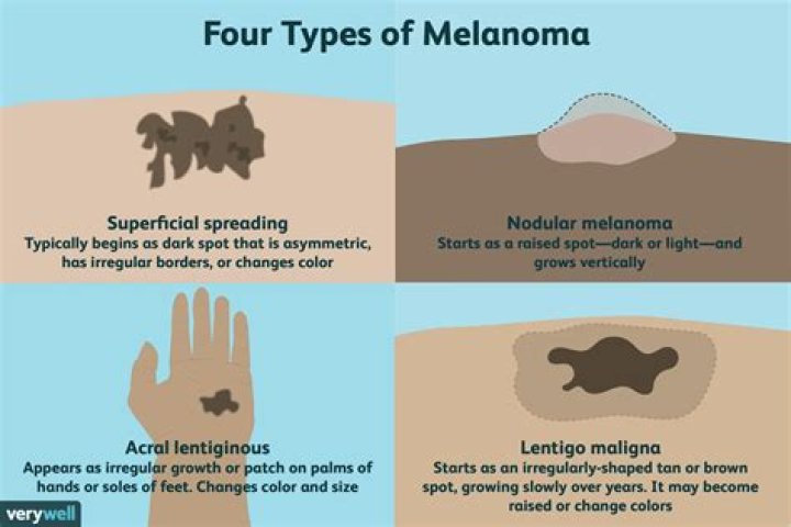 What part of the body does melanoma generally affect?