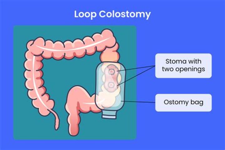 What should stoma output look like?