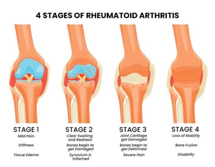 What slows down the progression of arthritis?