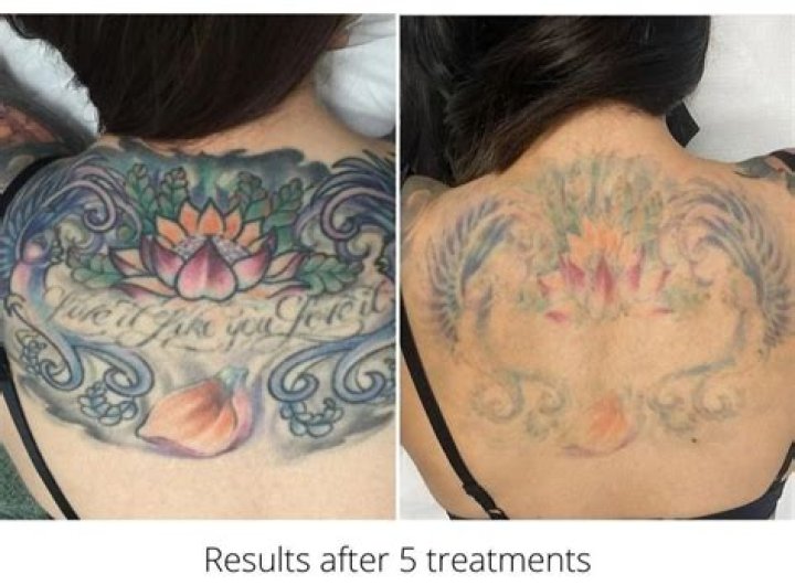 What tattoos are easier to remove?