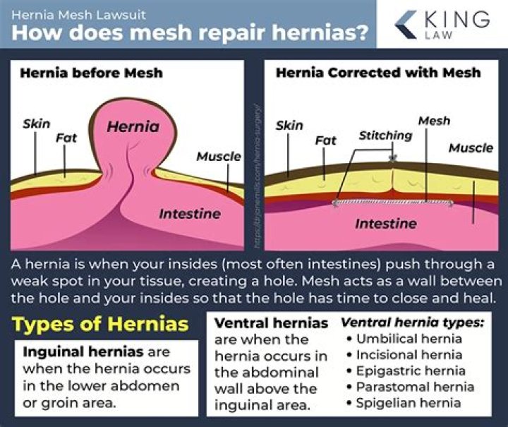 What type of hernia is most severe?