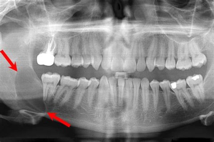 What's the difference between an abscess and a cyst?