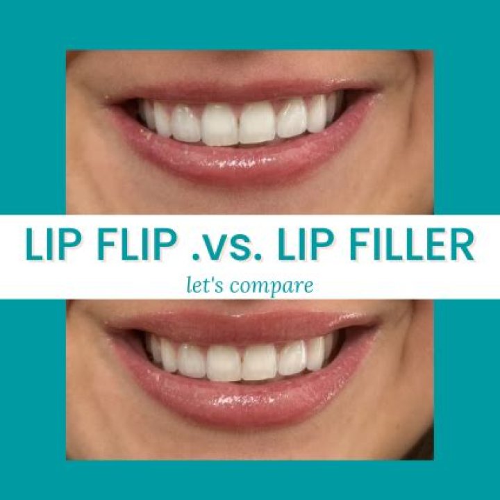 What's the difference between lip flip and gummy smile?